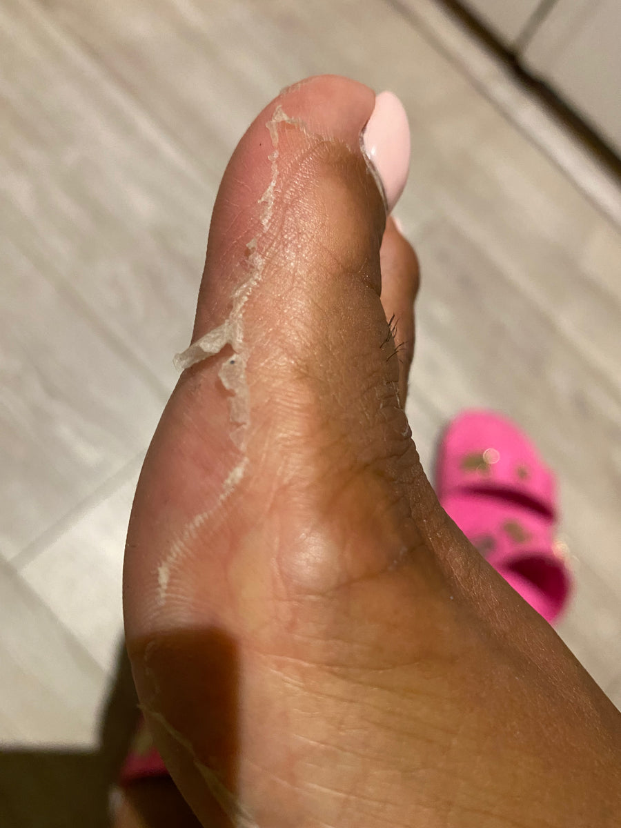 Chemical online foot peel
